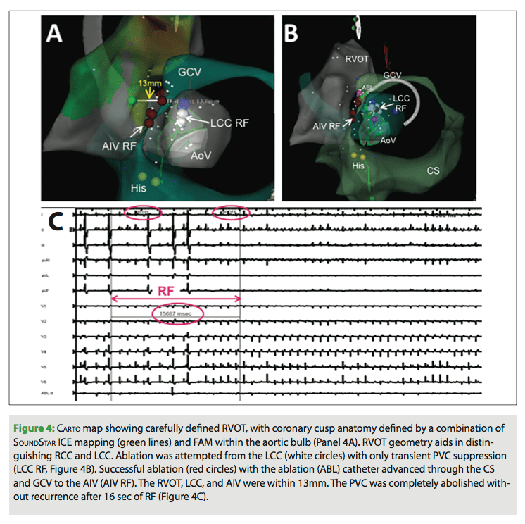 PVC Ablation An Evolving Niche for Adult Electrophysiologists