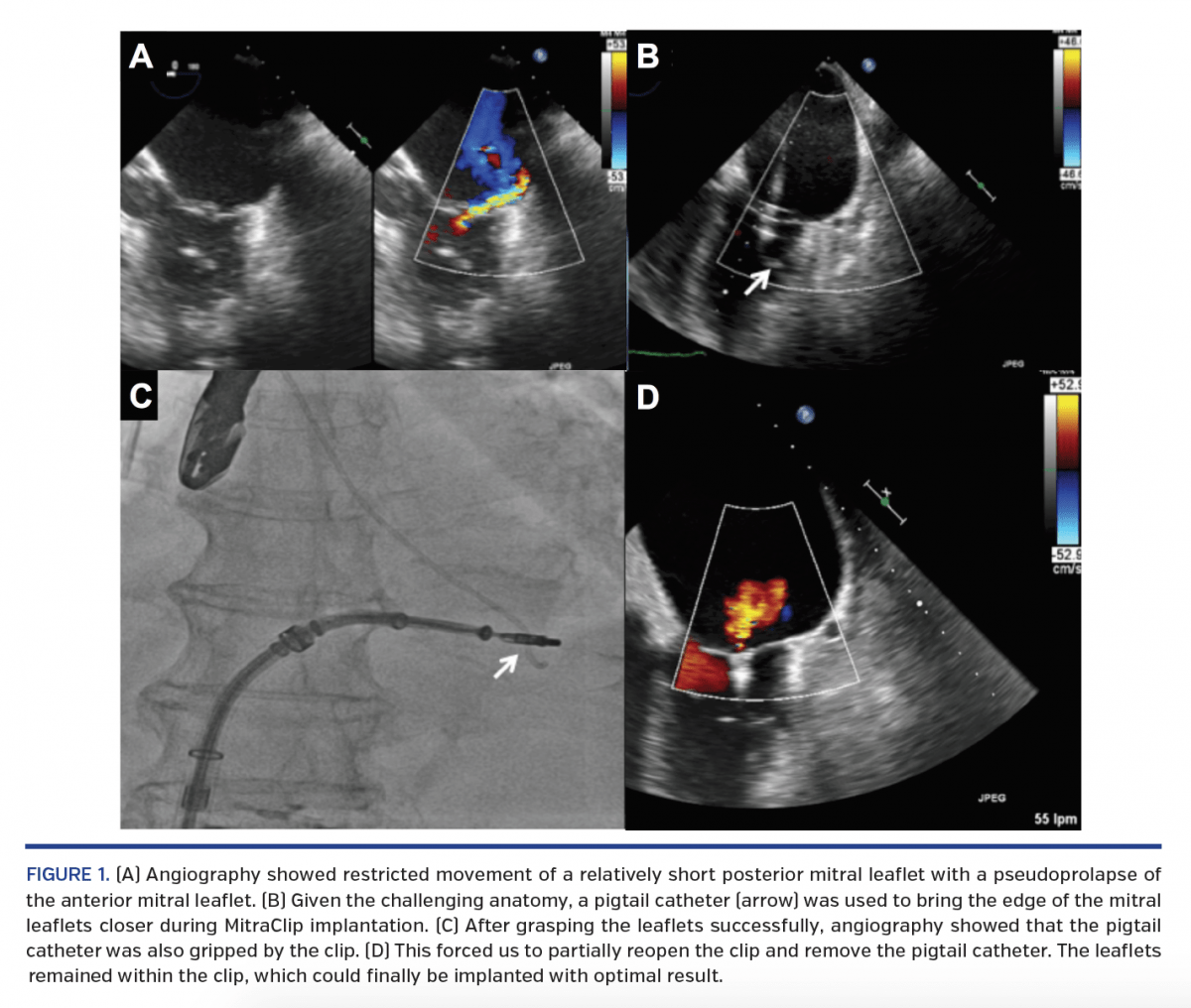 Catheter Entrapment During Posterior Mitral Leaflet Pushing Maneuver