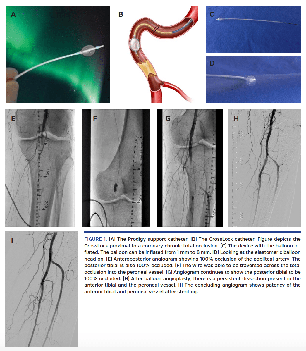 A Step Forward The Use of the CrossLock Catheter in a Patient With