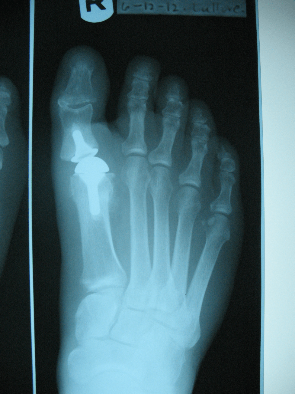 Pertinent Insights On Total Joint Replacement Of The First MPJ