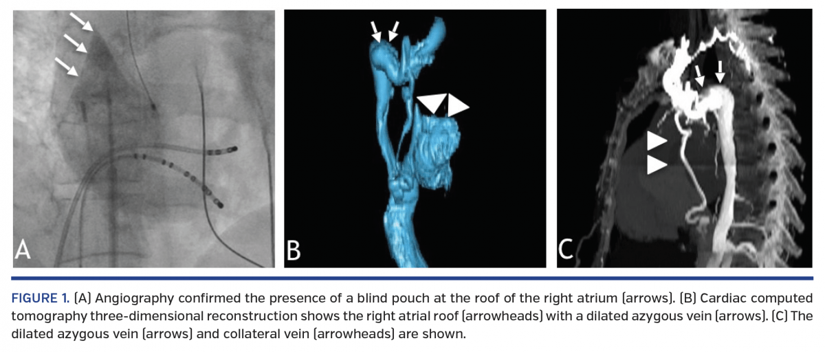 Electrophysiology Study and Catheter Ablation With Superior Vena Cava Stump