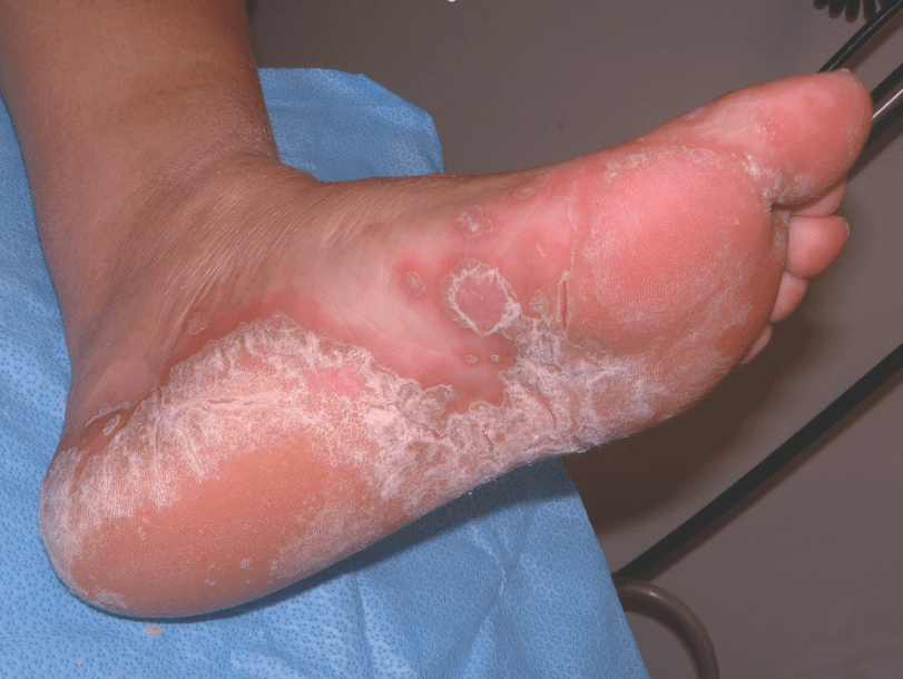 Treating Fungal Infections In Patients With Wounds