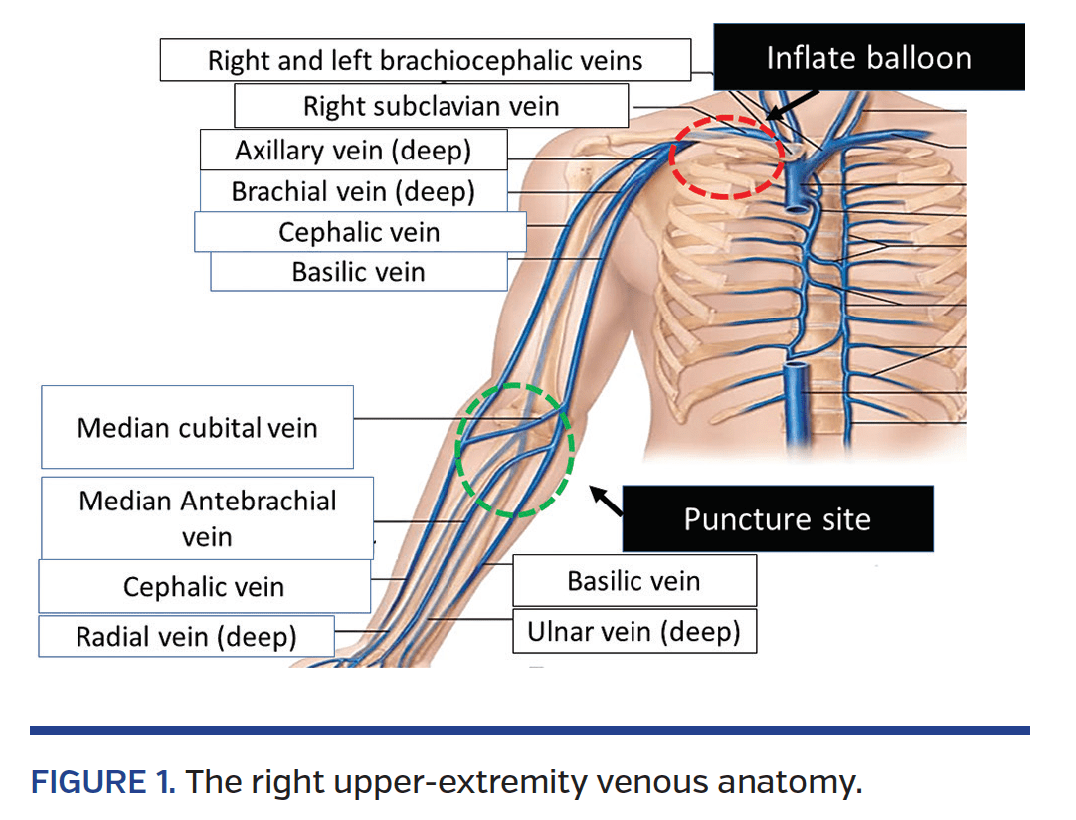 Antecubital Fossa Venous Access For Right Heart Catheterization