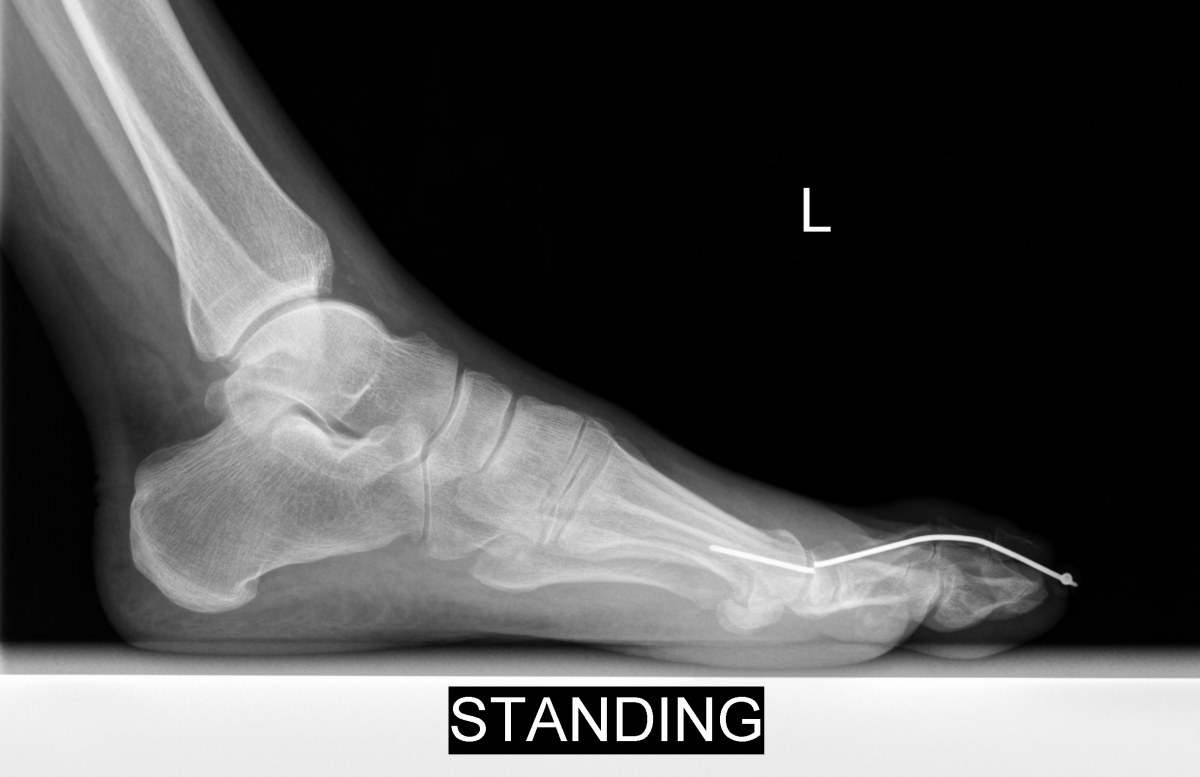 Hammertoe Fixation And CostEffectiveness What Are The Best Options?