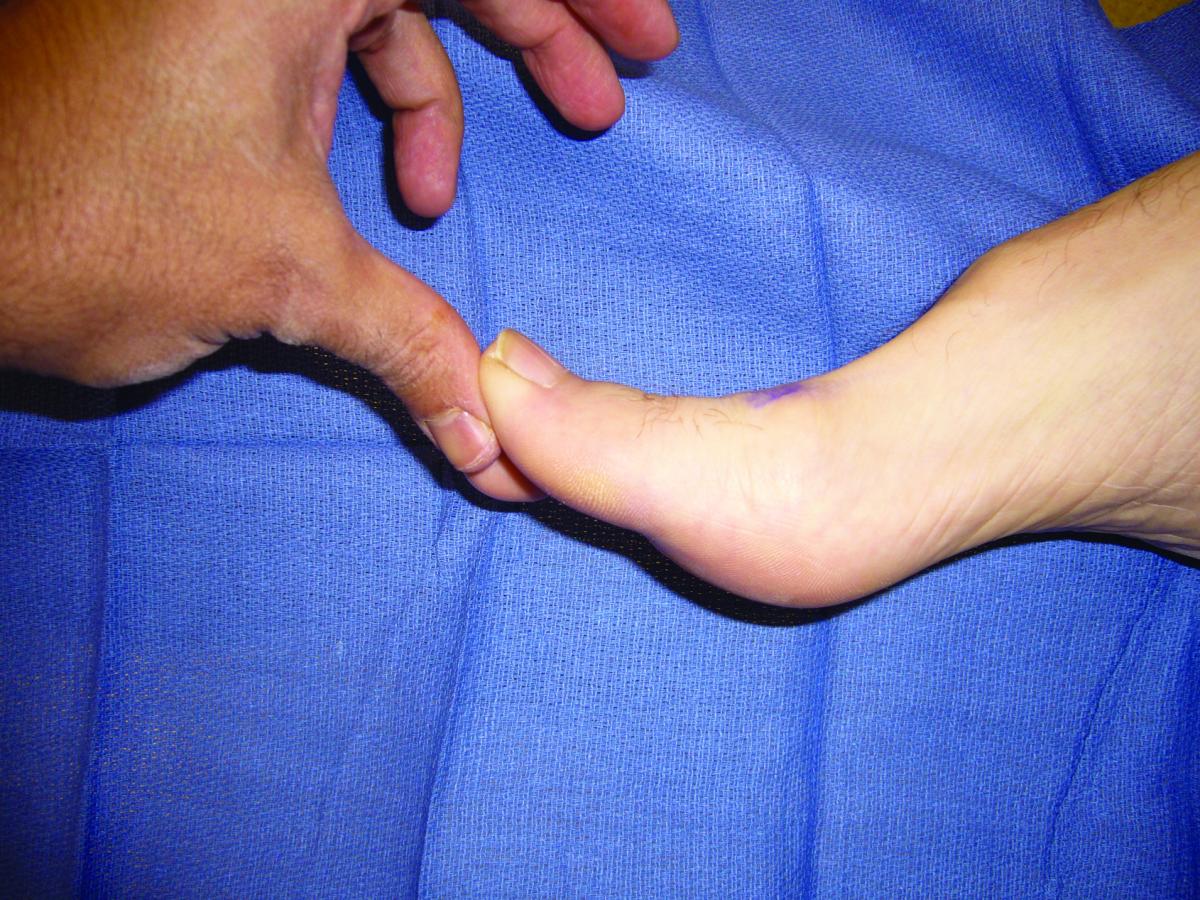 Hallux Rigidus Cheilectomy