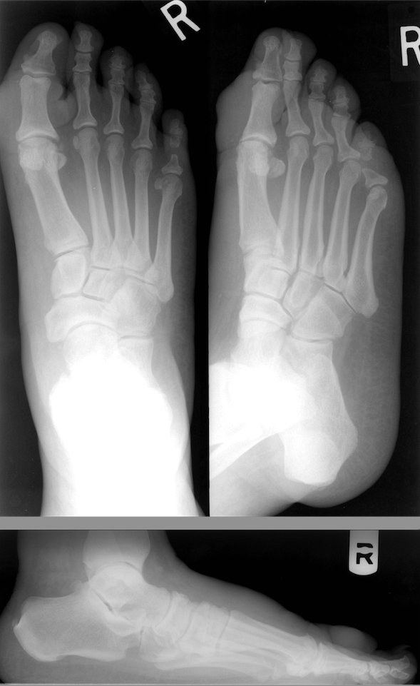 Current Insights On Treating Graves’ Dermopathy In The Foot