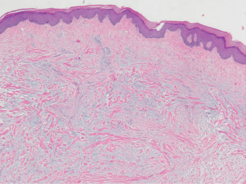 Current Insights On Treating Graves’ Dermopathy In The Foot