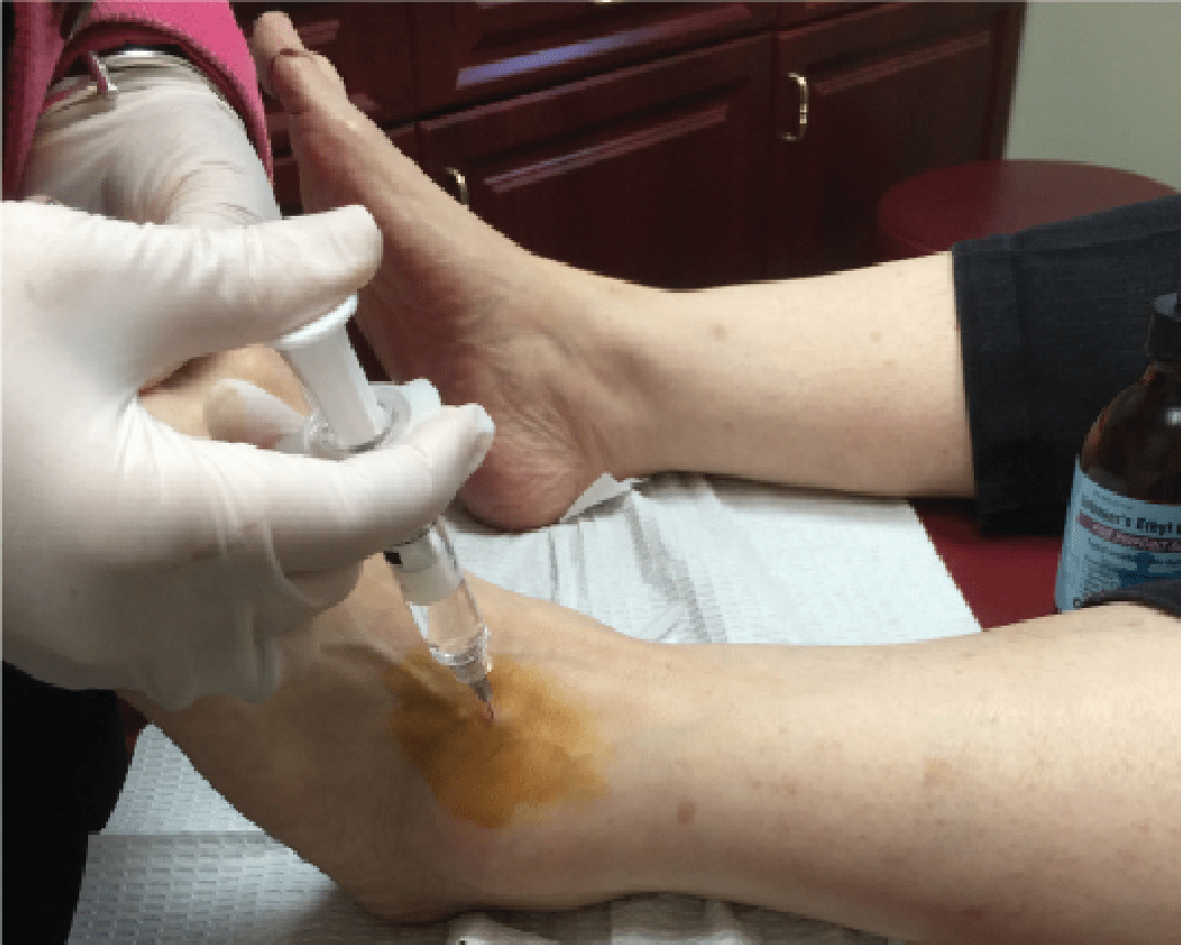 Viscosupplementation Can It Have An Impact For Ankle Arthritis?