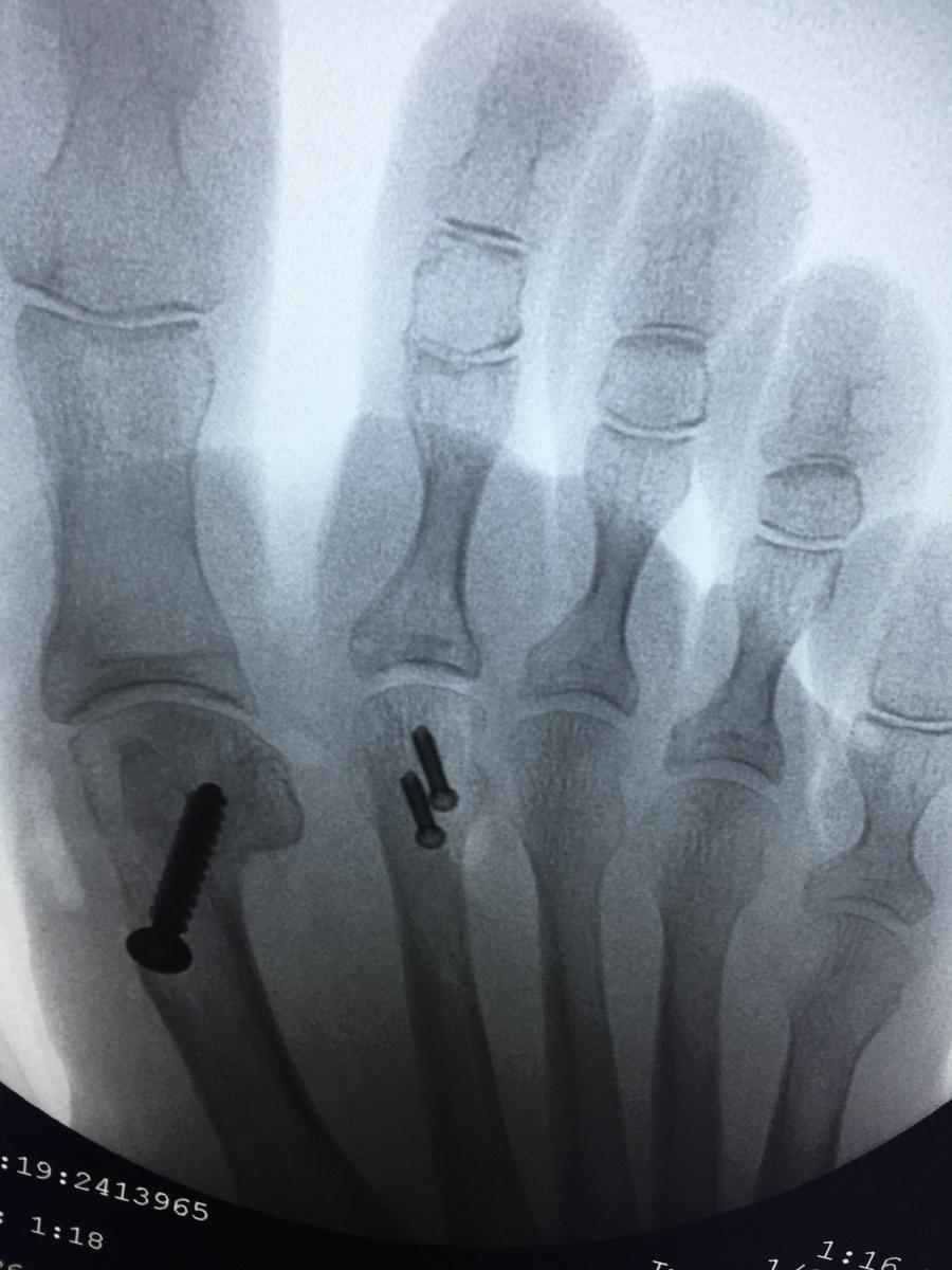 Expert Insights On Treating Plantar Plate Tears