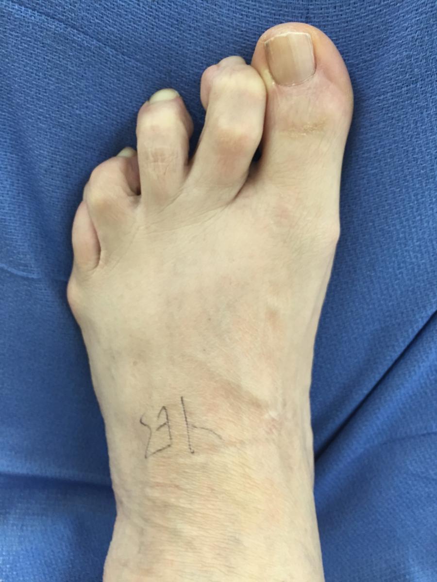 Expert Insights On Treating Plantar Plate Tears