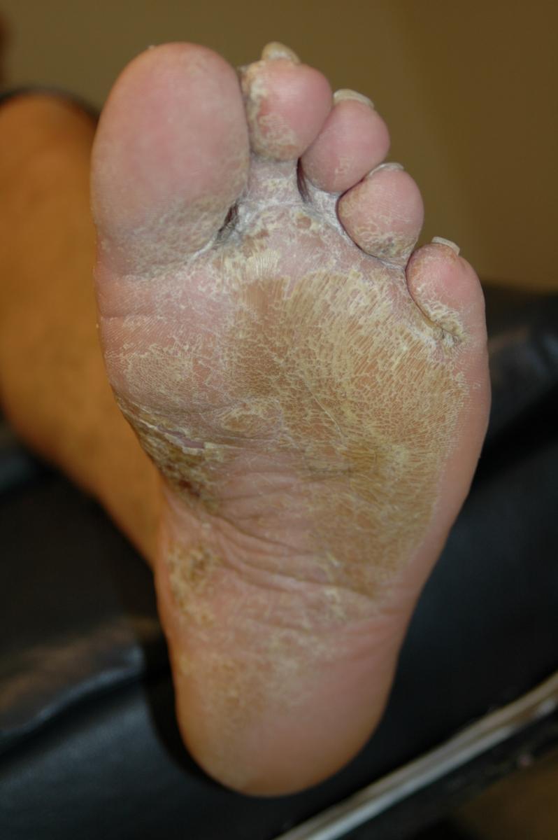 Hyperkeratosis Feet