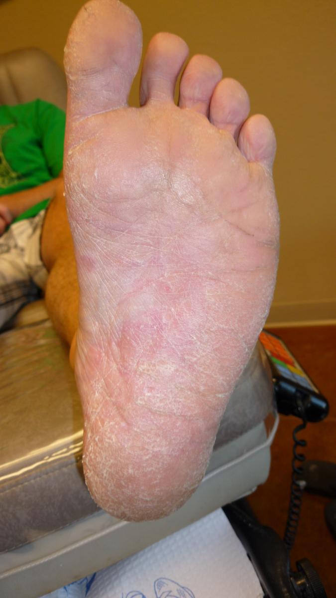 Thick, Yellow Skin On Soles Of Feet Clinical Advisor, 51 OFF