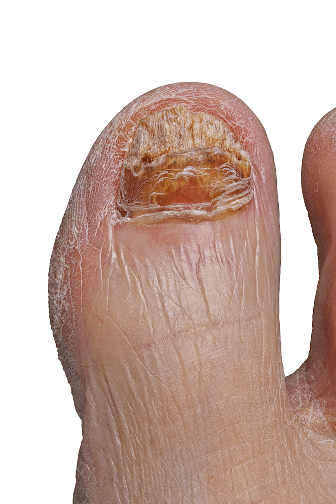 An Update On Current And Emerging Topical Antifungals