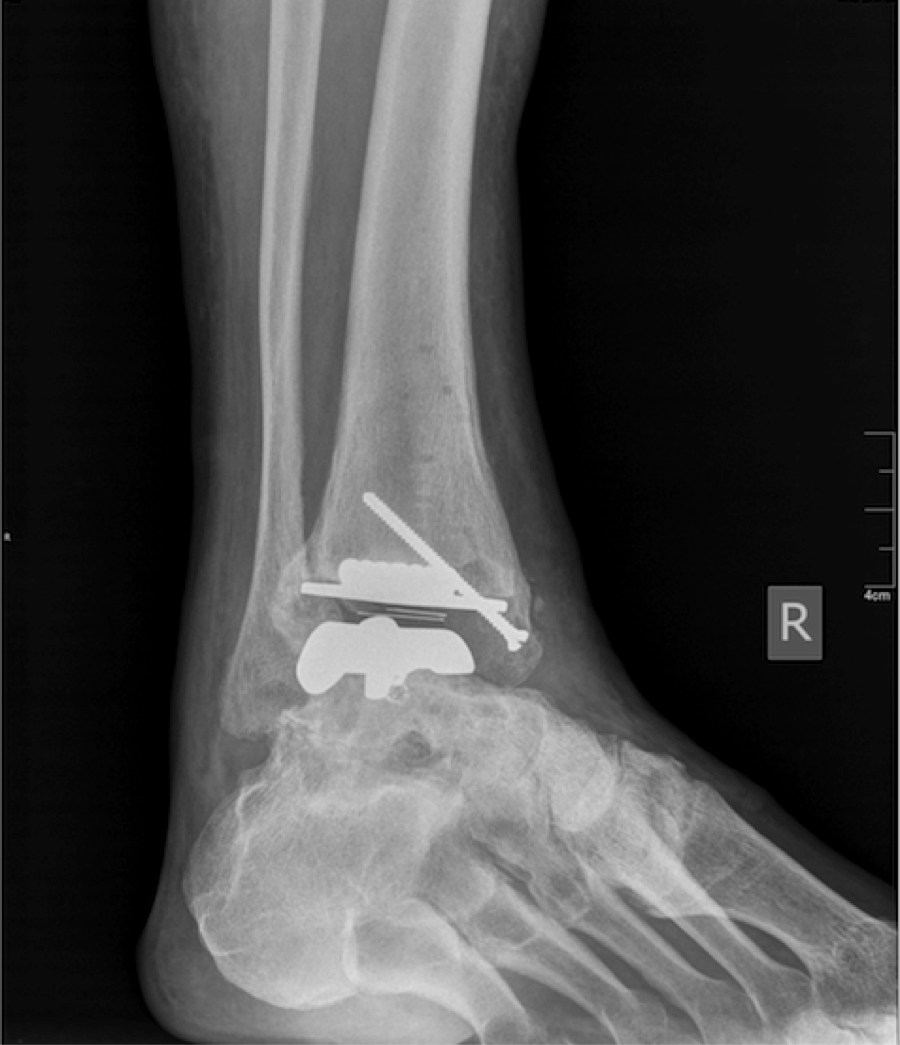 Current Insights On Total Ankle Replacement With Concurrent Endoscopic Gastrocnemius Recession