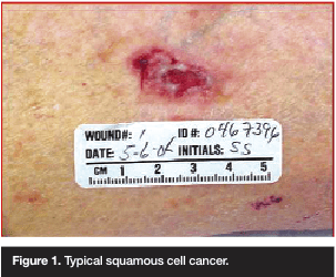 Skin Cancers And Wounds In The Geriatric Population: A Review