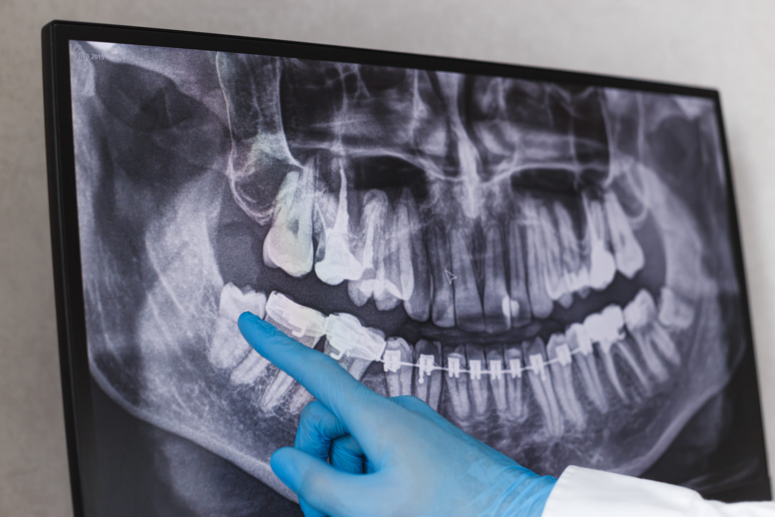 Will Wisdom Teeth Ruin My Treatment with Braces? Reddick Orthodontics