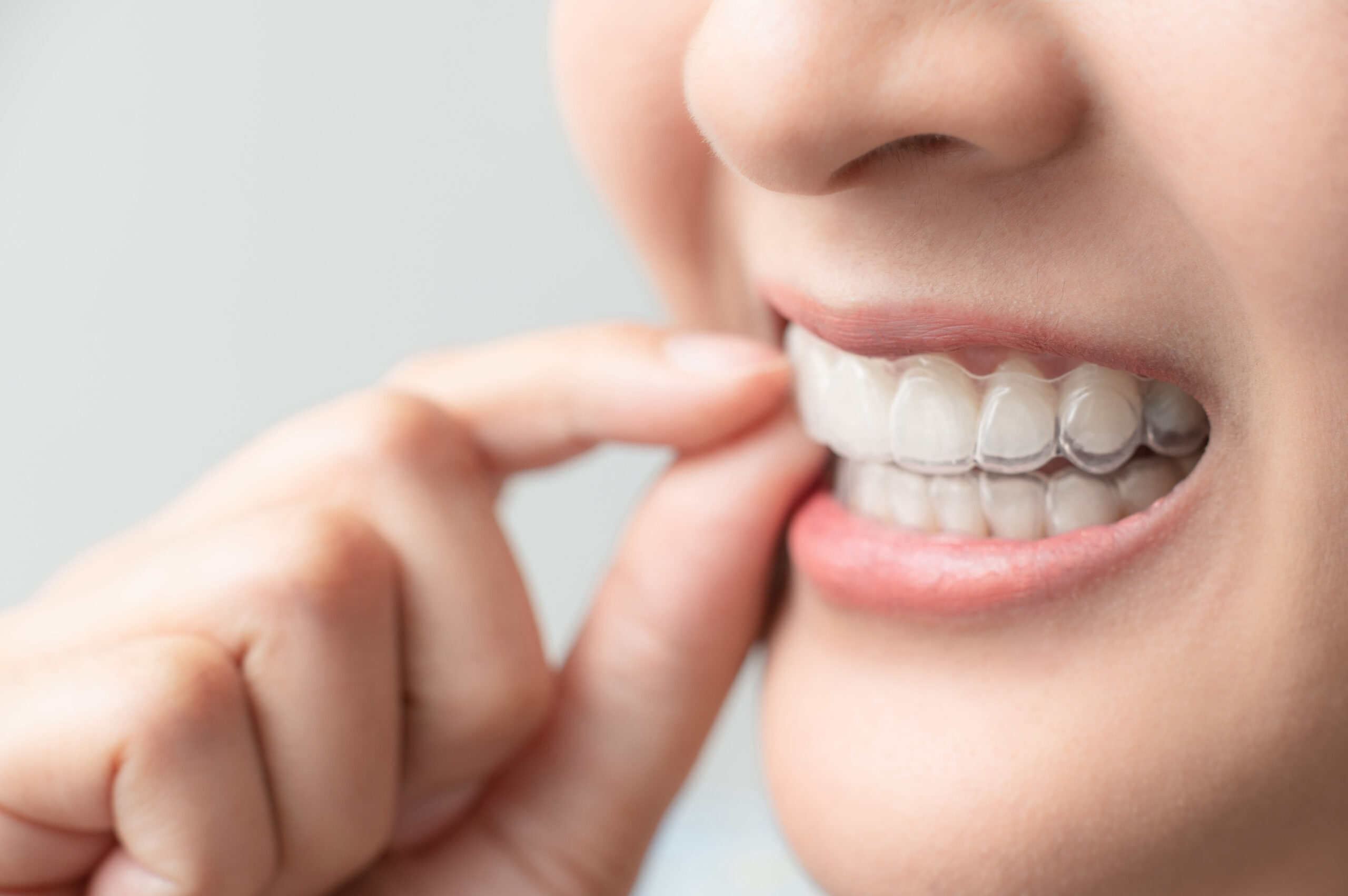 Tell Me About Invisalign Reddick Orthodontics Treatment Options