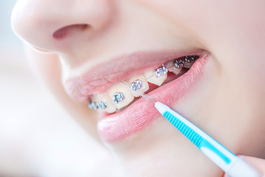 The Right Way to Clean Your Braces Valderrama Orthodontics