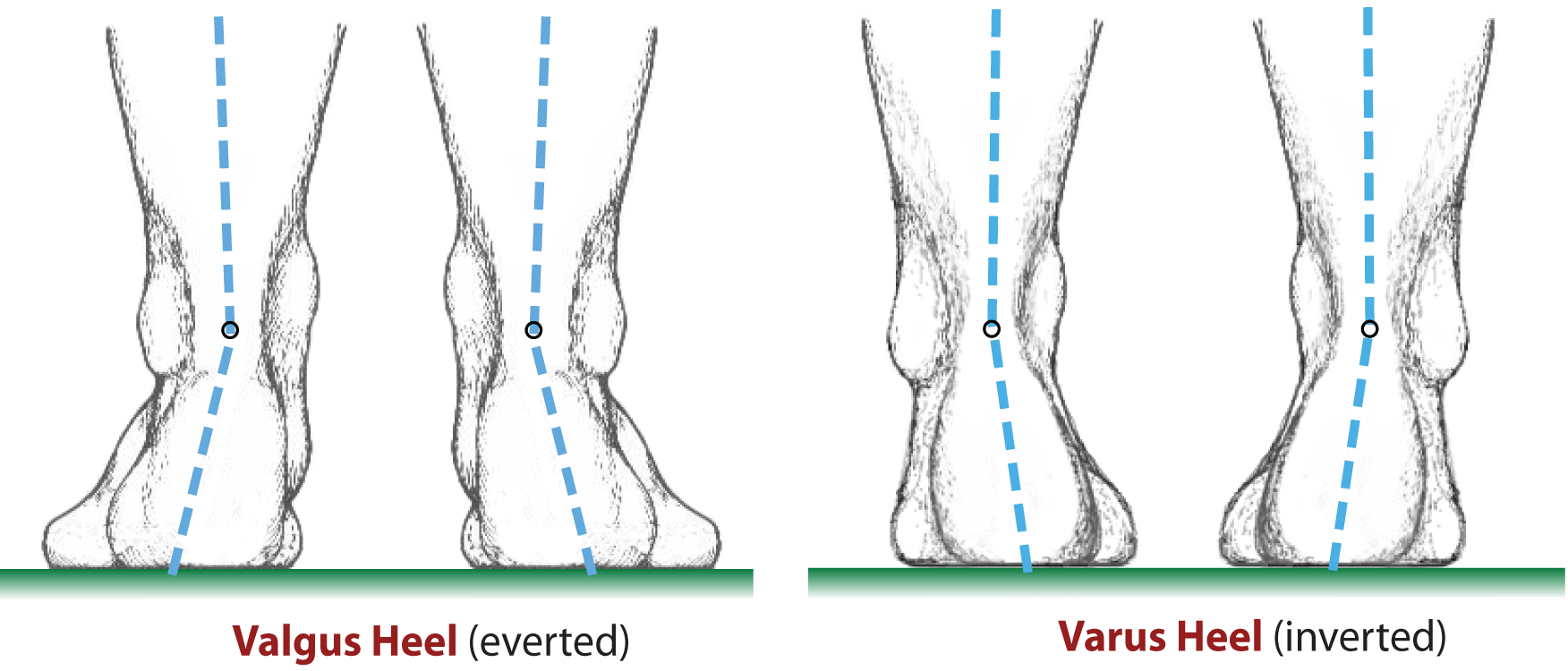 Hindfoot Alignment