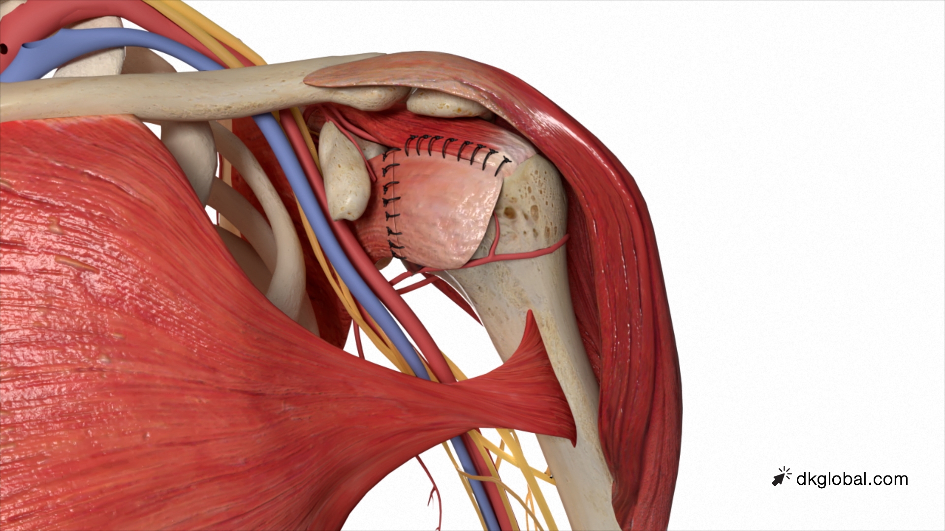 DK Global Case Feature 5.29M Verdict for Amputee in Shoulder