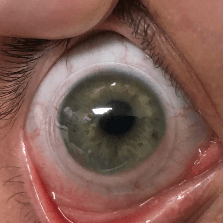 Looking for Scleral Contact Lenses in Edmonton?