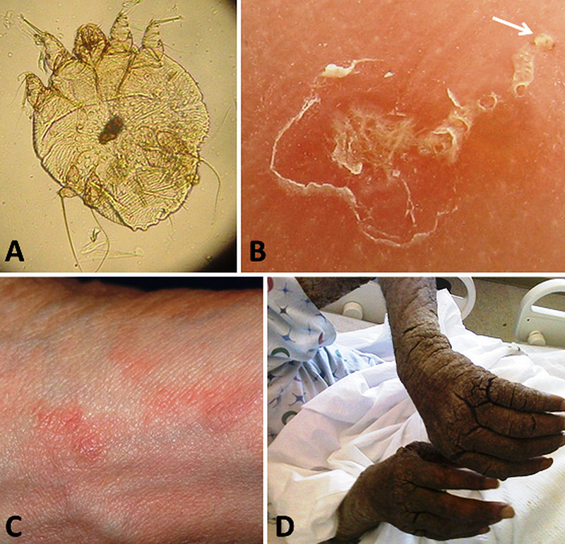 Scabies Encyclopedia of Arkansas