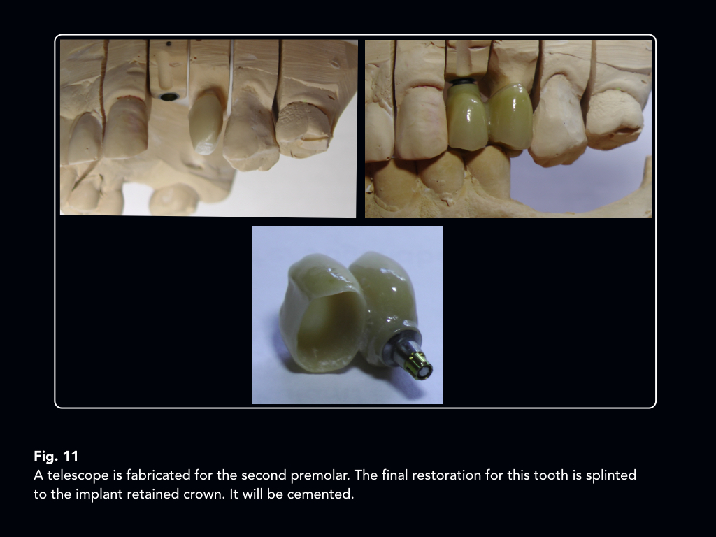 An implant supported telescopic crown convertible to a cantilever