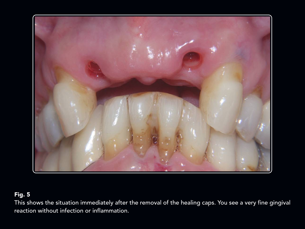 A fourunit anterior bridge how many implants and where to put them