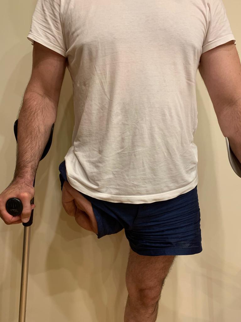 Surgery for Amputated Leg Fundly