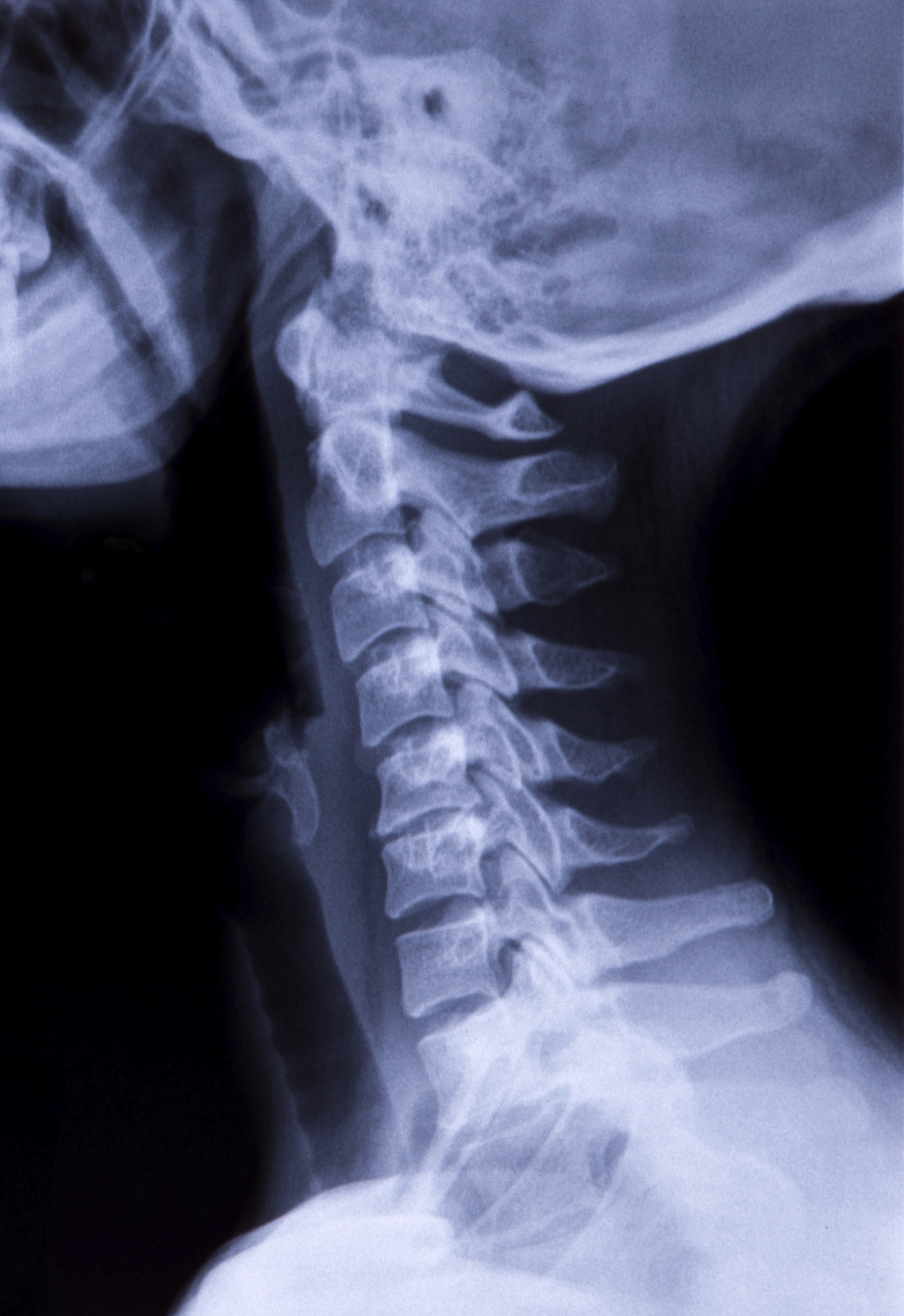Neck fracture New Doctor Insights