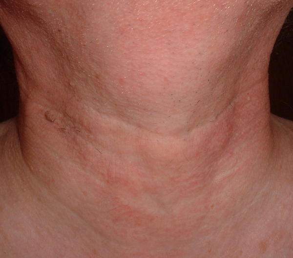 Health Topics Blogs Throat Cancer Pictures