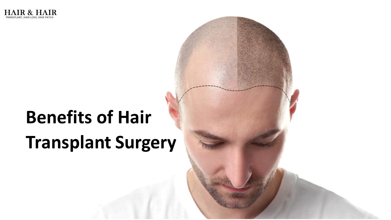 PPT Benefits of Hair Transplant Surgery PowerPoint presentation