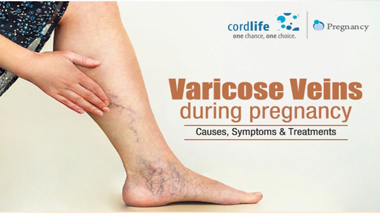 PPT Varicose Veins During Pregnancy Causes, Symptoms & Treatments