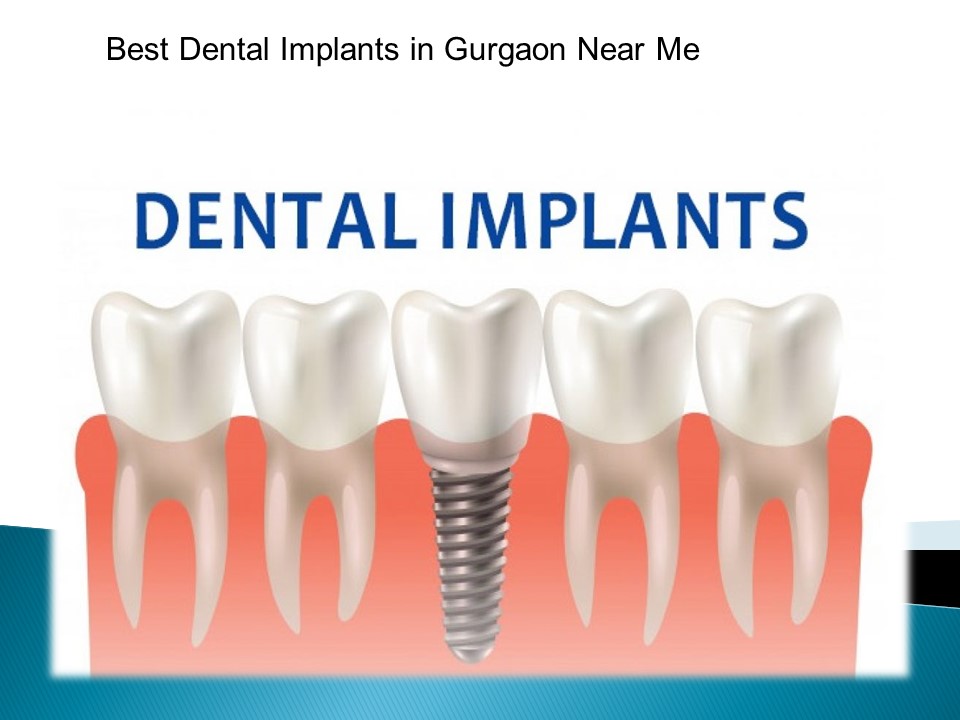 PPT dental Implant centre in gurgaon PowerPoint presentation free