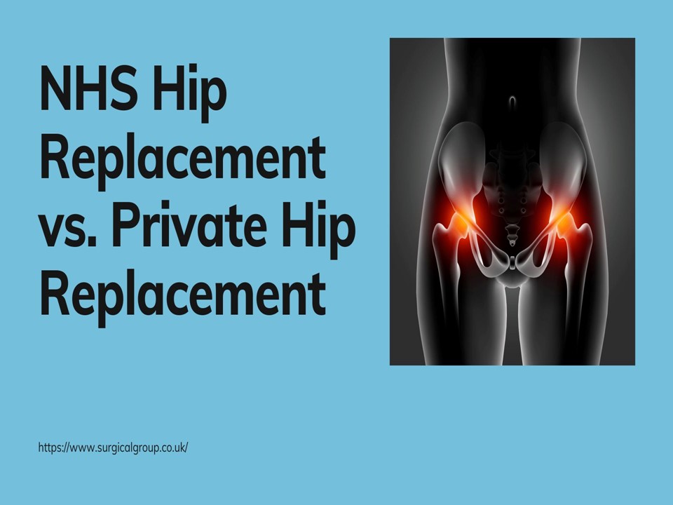 PPT NHS Hip Replacement vs. Private Hip Replacement PowerPoint