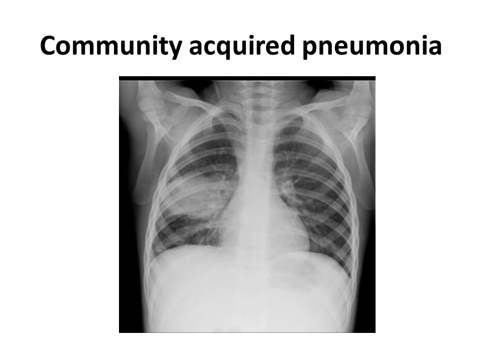 PPT Community acquired pneumonia and Bronchiolitis reports by Dr