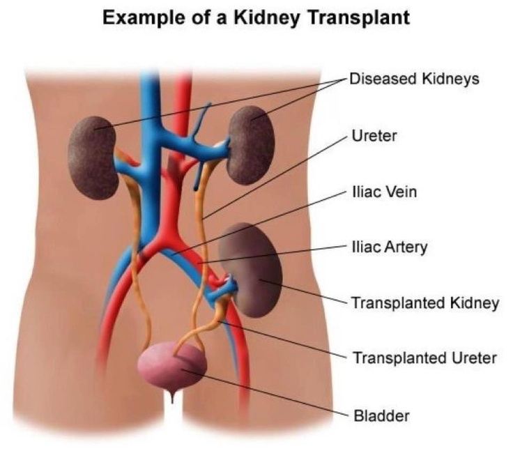 Transplantation Renal Replacement Therapies LibGuides at Health