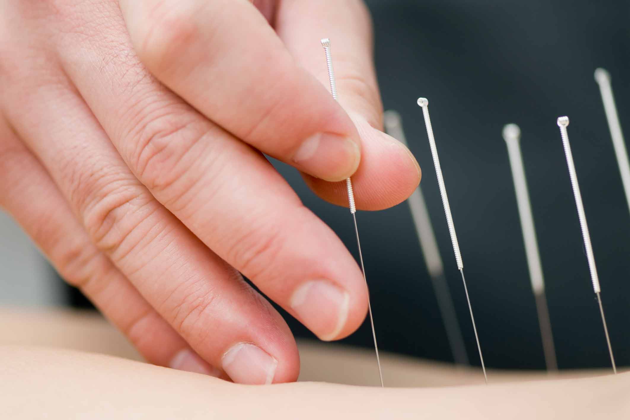 Using Acupuncture for Fibromyalgia Pain Relief PainScale