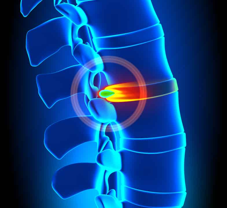 Location of Disc Herniation May Affect Following Lumbar