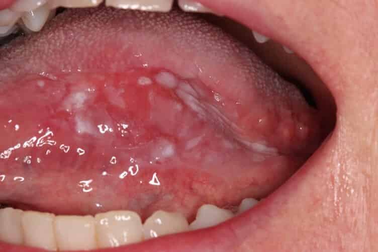 Oral leukoplakia an update for dental practitioners Published in
