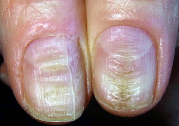 12 Gross Reasons To Stop Biting Your Nails Today Simplemost