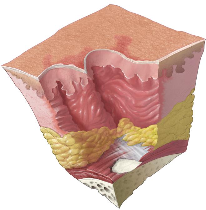 Staging Pressure Ulcers RIT