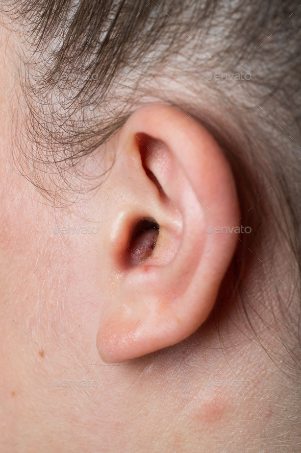 Close up of abscess Inflammation on the ear, area of suppuration. Ear