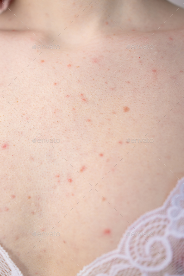 teenage girl have a lot of red spots on her chest. From acne hormones