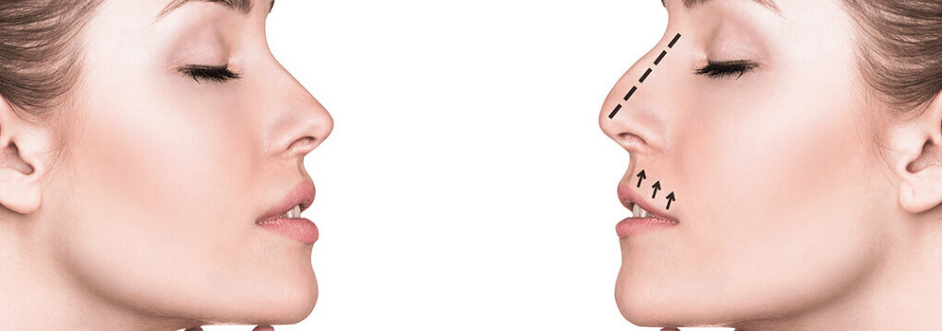 How Much Does A Nose Job Cost In South Carolina Job Drop