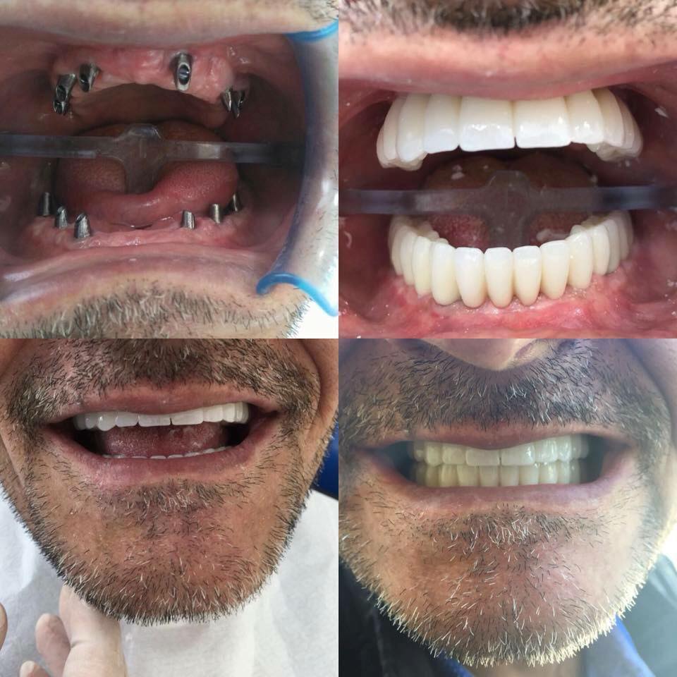 Allon6 Dental Implants in Turkey The BEST 12 clinics ‎ Prices 2020