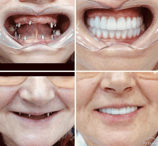 Dental Implants Abroad Comprehensive Guide 2024