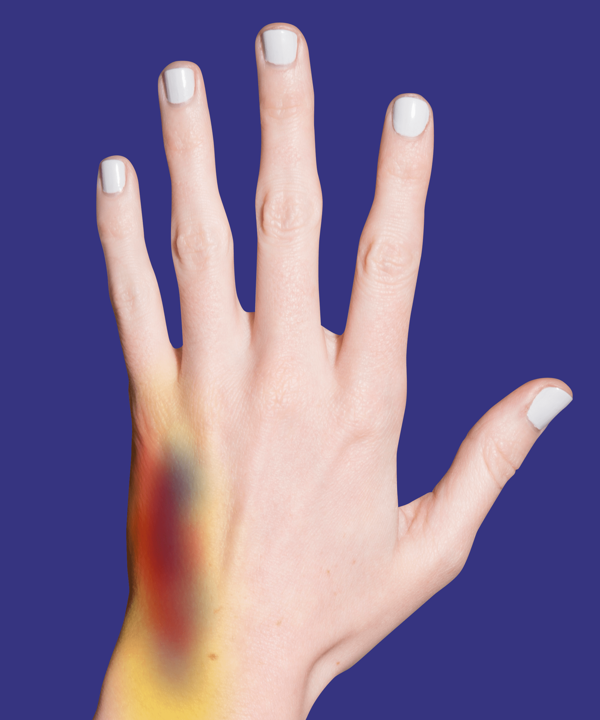 Can Too Much Vitamin D Cause Bruising