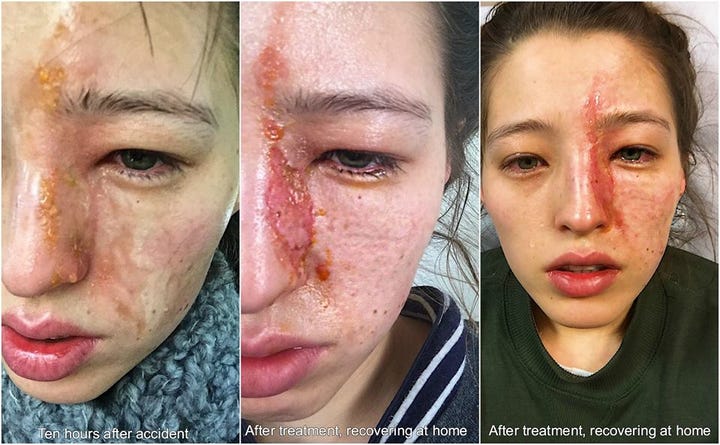 Essential Oil Diffuser Dangers, Chemical Skin Face Burn