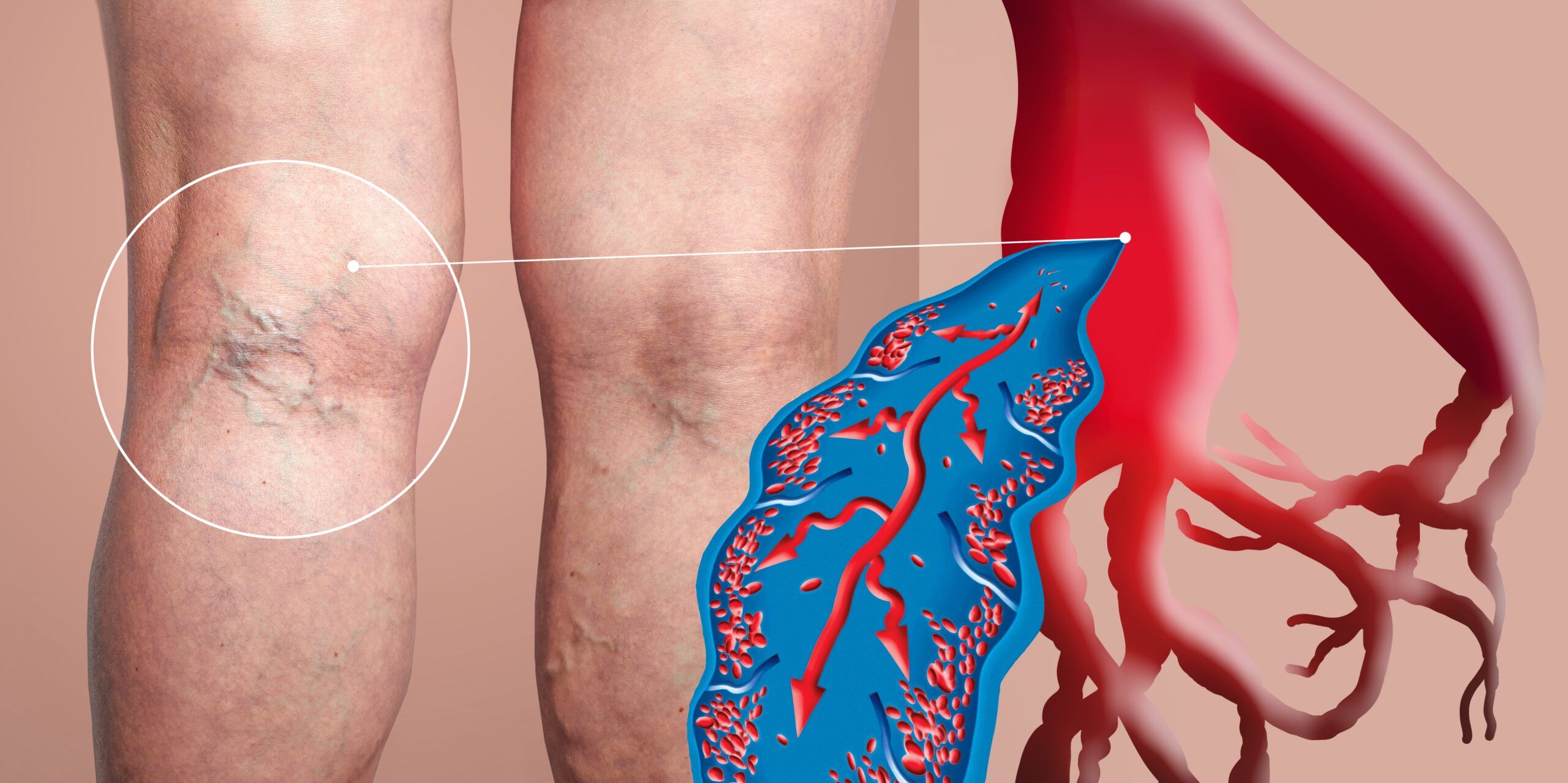 Deep Vein Thrombosis (DVT) Apex Vascular
